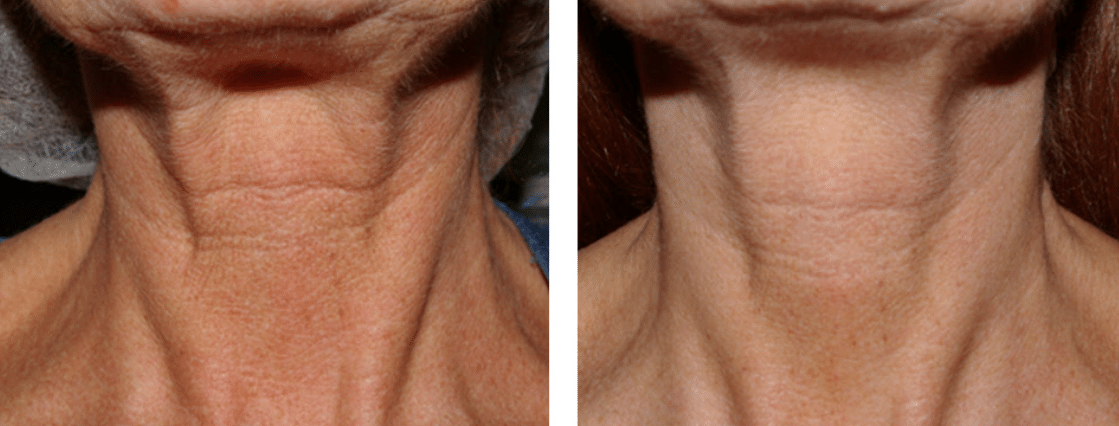 microneedling-before-and-after-neck-tightening