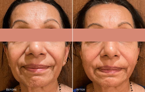 Thread Lift Before & After Gallery - Patient 424854 - Image 1