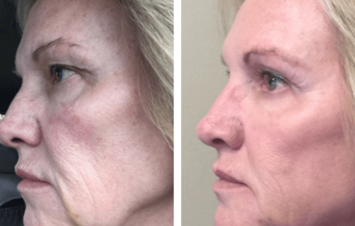 Thread Lift Before & After Gallery - Patient 394135 - Image 1