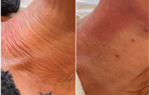 Thread Lift Before & After Gallery - Patient 203790 - Image 1
